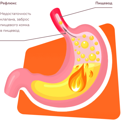 Изжога в желудке